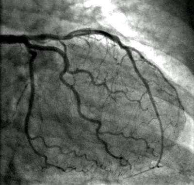 Angiogram